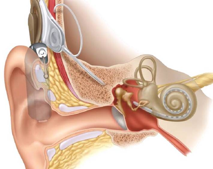 Cochlear Implant Clinic